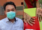 Satu Warga Palembang Suspek Cacar Monyet