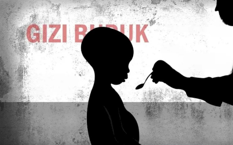 Ilustrasi Gizi Buruk. (ist/rmolsumsel.id) 